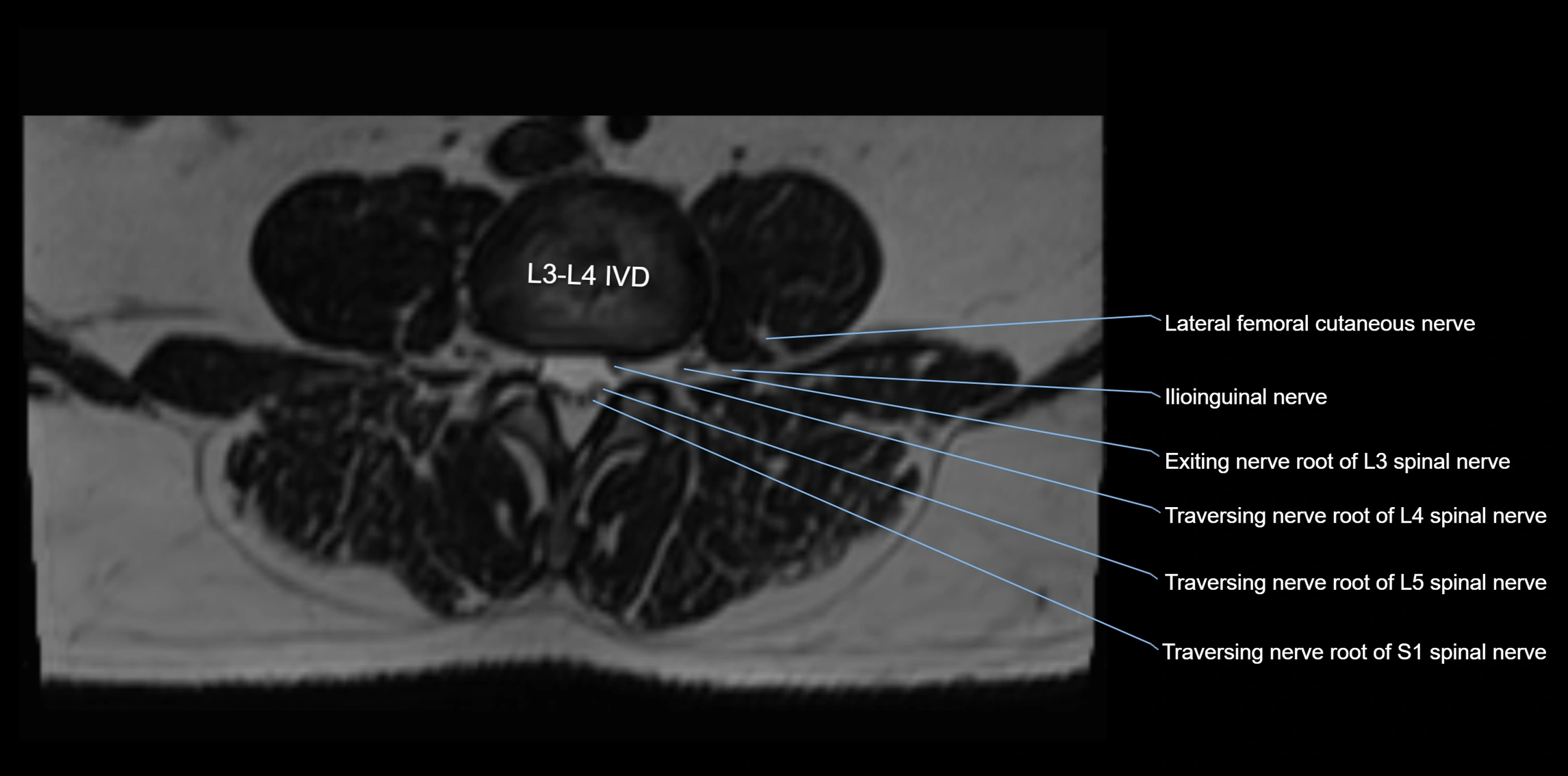 MR lumbosacral plexus axial cross sectional anatomy 3T  radiology  image-img-1008001-00030.webp